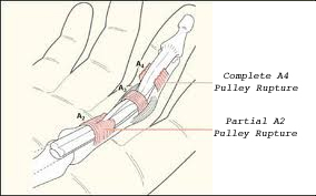 Pulley Rupture seen in Climber's finger